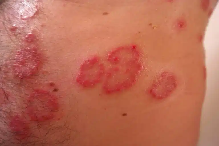 dermatite psoriasi