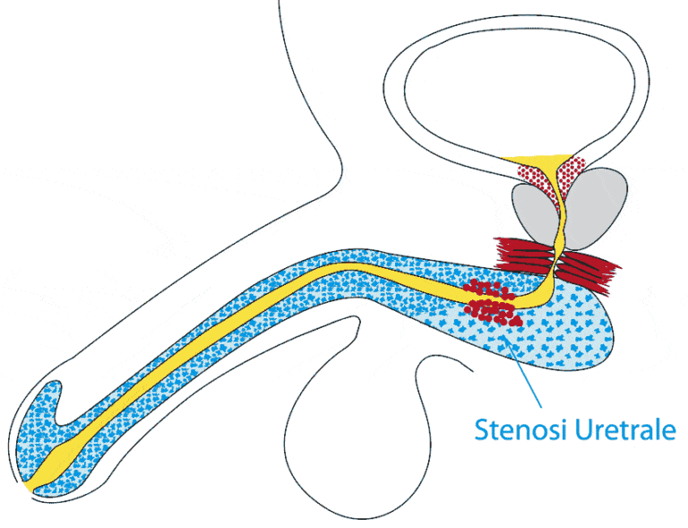stenosi-uretrale