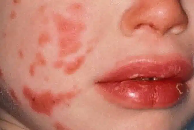 sindrome di kawasaki