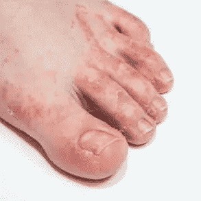 si staccano pezzi di pelle tra le dita dei piedi