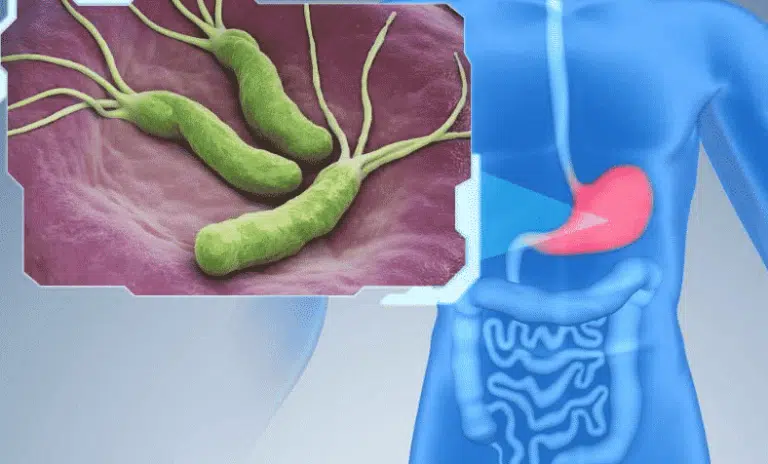 helicobacter pylori