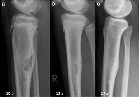 Lastra di un fibroma non ossificante tibiale