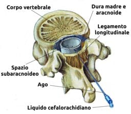 Descrizione sede per anestesia spinale