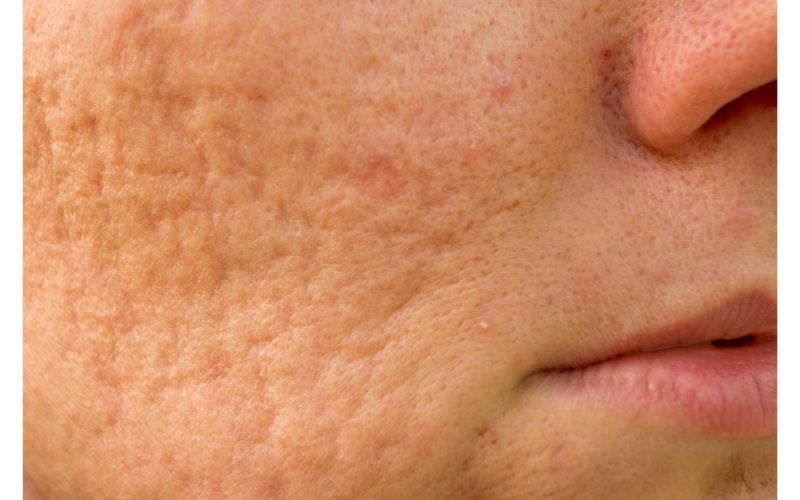 come eliminare le cicatrici da acne