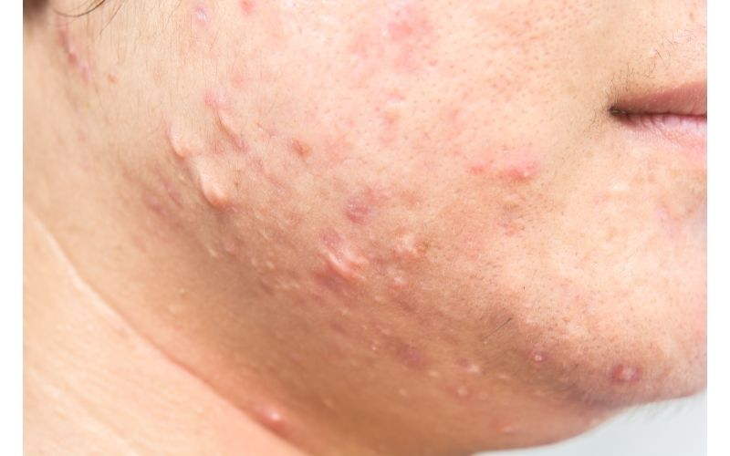 come eliminare le cicatrici dell'acne