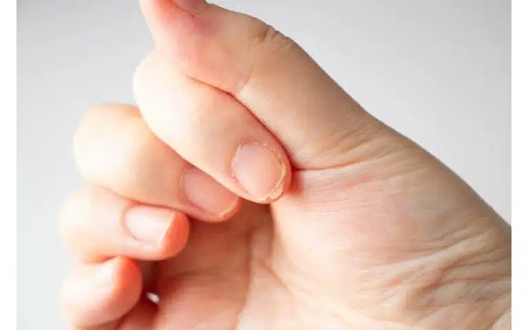 psoriasi alle unghie