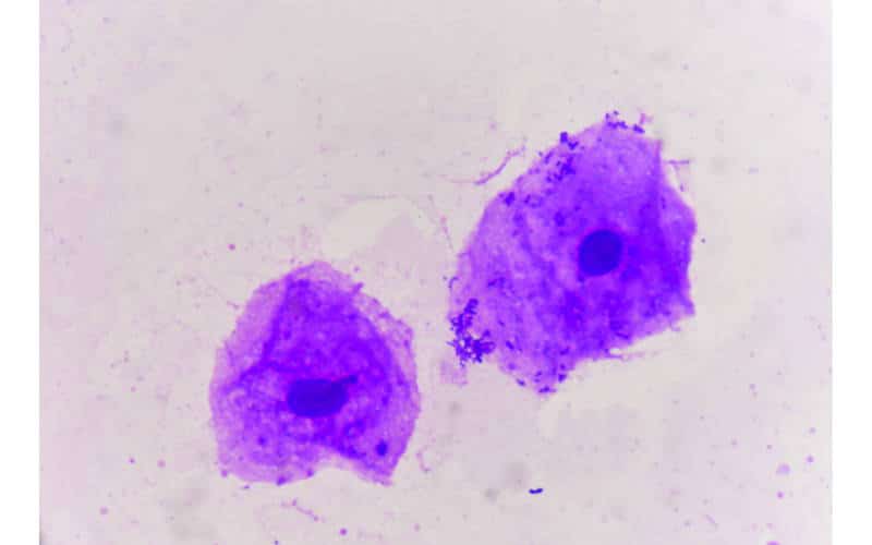 cellule epiteliali pavimentose urine