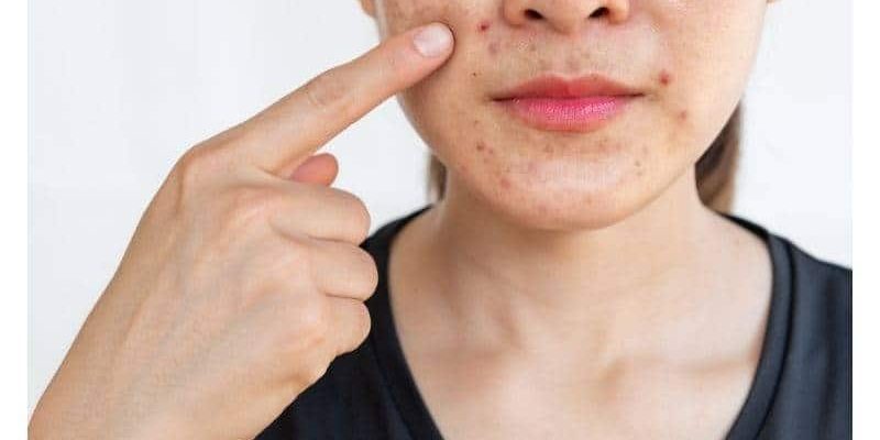 acne comedonica cause