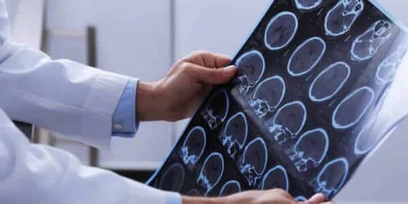 Medico neurologo tiene in mano una lastra del cervello