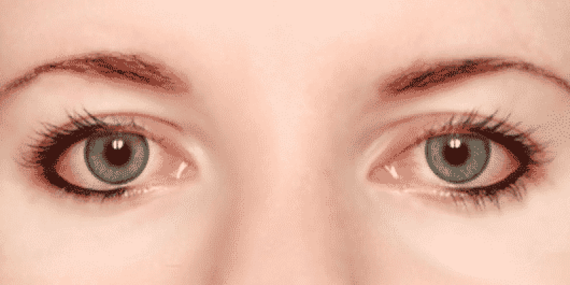 infiammazione grave dell'occhio