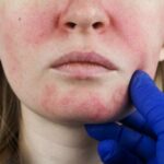 paziente con pelle del viso arrossata per visita dermatologica