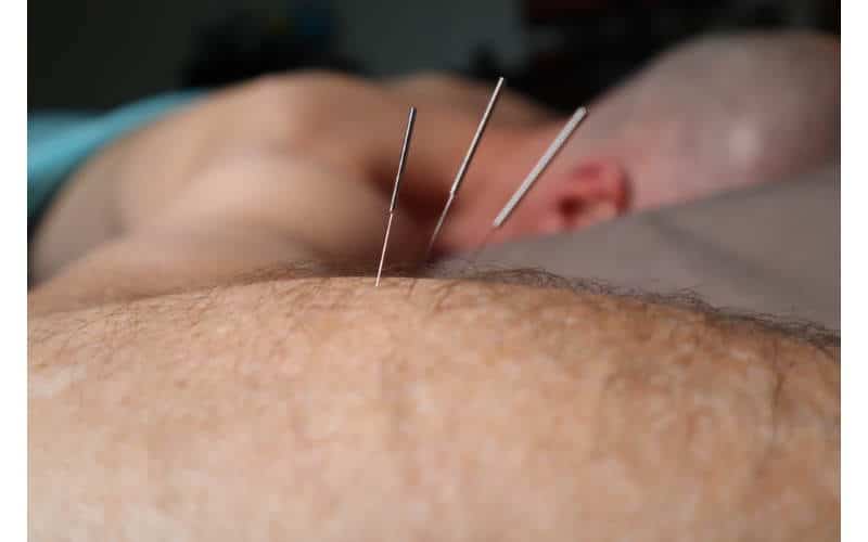 psoriasi e agopuntura